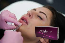 پرکننده پوست اسید هیالورونیک متقاطع زنانه Juvederm Lip Filler Ultra 3 Ultra 4