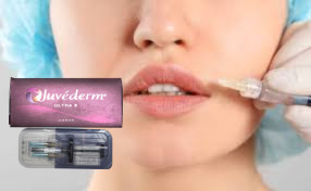 2 * 1 میلی لیتر Juvederm Ultra 3 Lip Filler Hyaluronic Acid Gel Fillers 2 * 1 میلی لیتر Juvederm Ultra 3 Lip Filler هایلورونیک اسید ژل پر کننده