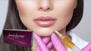 Juvederm Ultra 3 اسید هیالورونیک HA پرکننده پوستی 2 میلی لیتر افزایش لب