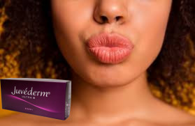 Juvederm Ultra 3 Ultra 4 پرکننده اسید هیالورونیک برای افزایش لب
