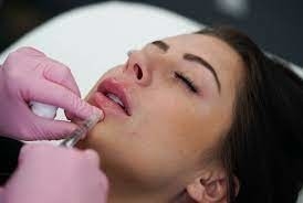 GMP Juvederm Ultra 3 HA پرکننده پوست برای لب Juvederm Vollure
